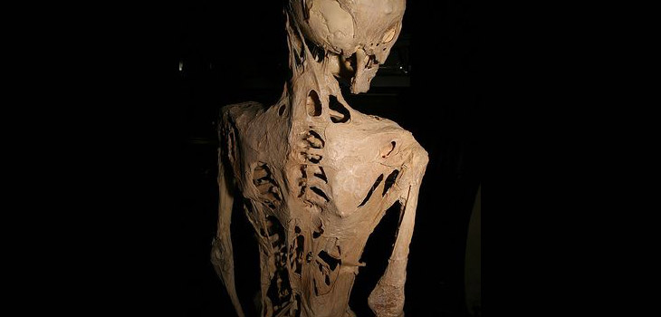 Drug May Aid With Rare Bone Disease