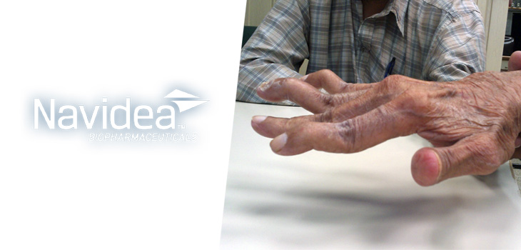 Navidea Biopharmaceuticals to Begin Trial for RA Drug