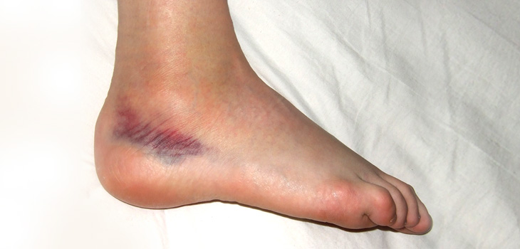 Ankle Sprains Not All Created Equal