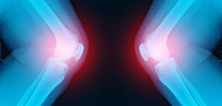 RA: New Drug Reduces Symptoms, Increases Functioning