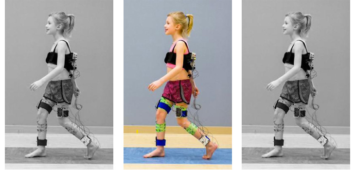 New Assessment for Cerebral Palsy Patients