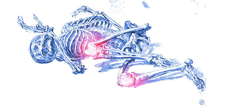 Zilretta: “Significant” Pain Relief for Knee OA