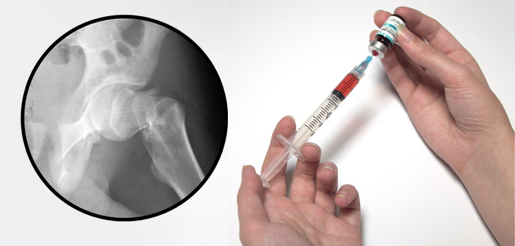 New Drug May Increase BMD, Reduce Fracture Risk