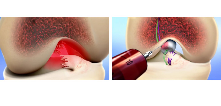 New Type of ACL Repair!