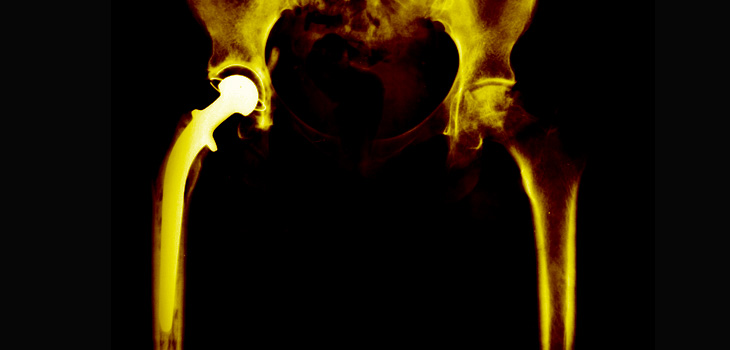 Older, Arthritic, Obese Patients More Likely to Convert to THA