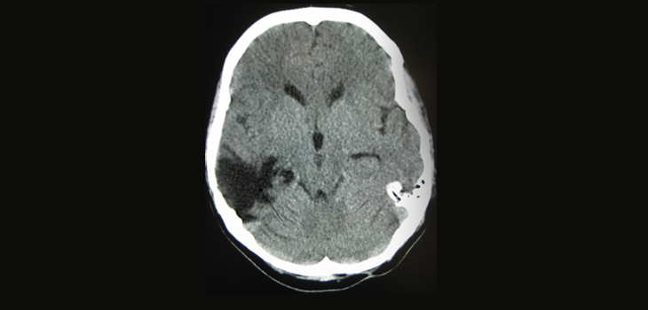 Brain Injury Problem in NFL Deepens