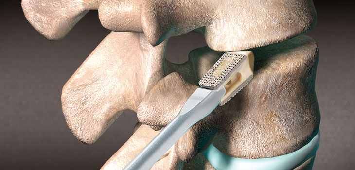 Orthofix Claims First PEEK/Titanium Lumbar Spacer