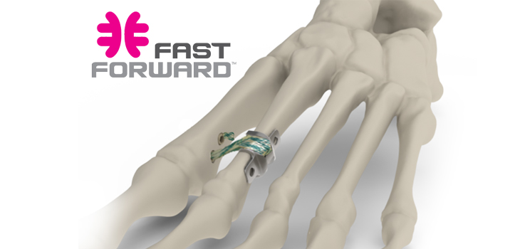 MedShape: First Outcomes for Bunion System