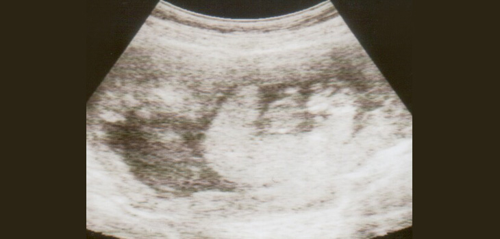 Larger Placentae at Birth Associated With Larger Childhood Bones