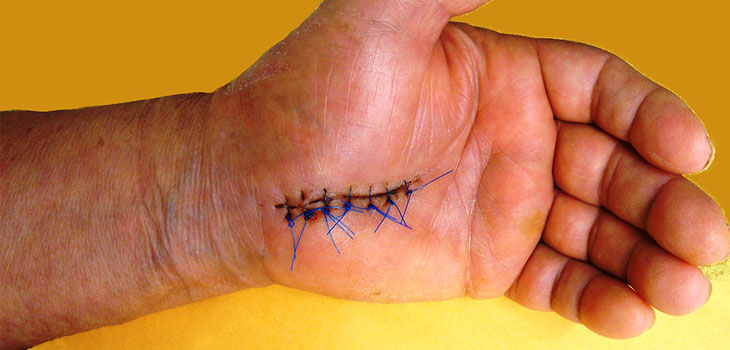 “Wide Awake Surgery” Recommended for Hands