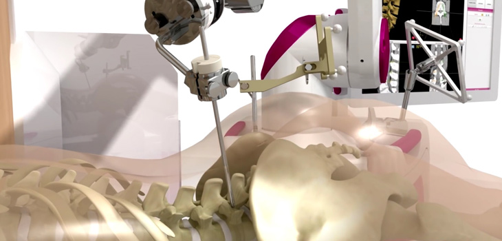 MEDTECH: 100 Surgeries With ROSA Spine