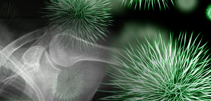 Open Surgeries: Major Infection Risk Post RC Repair