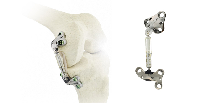 Atlas System for OA Patients: First Results
