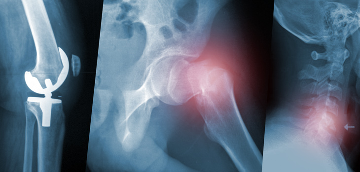 TKR…Then a Hip/Vertebral Fracture?