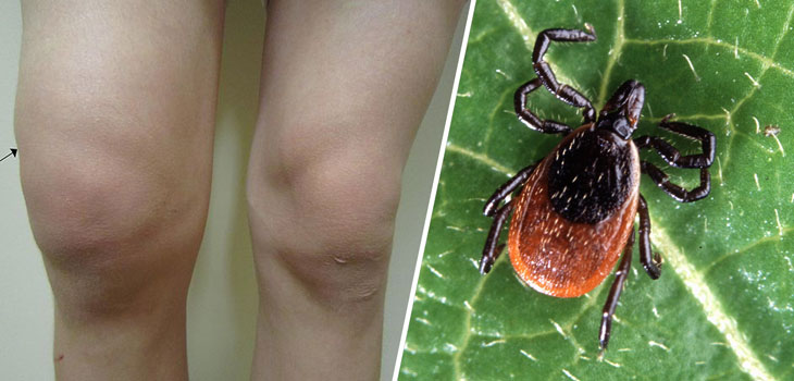 Is It Infectious Arthritis or Lyme Disease?