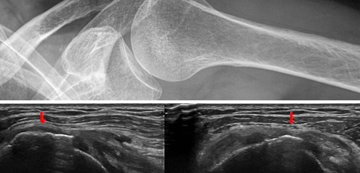 Shoulders Are the Focus of Three Important New Studies From Around the World