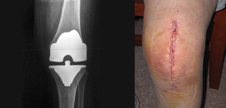 Researchers to Knee Patients: “Go Ahead and Shower”