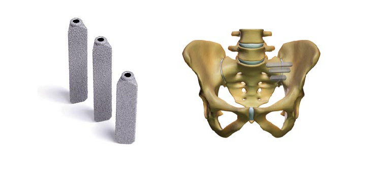 SI-BONE, Inc.: Coverage Revision Milestones!