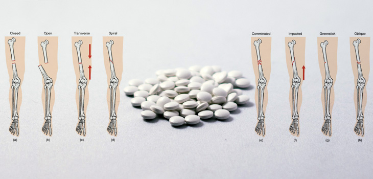 One-Third of Women Using Bisphosphonates at Risk for Fracture