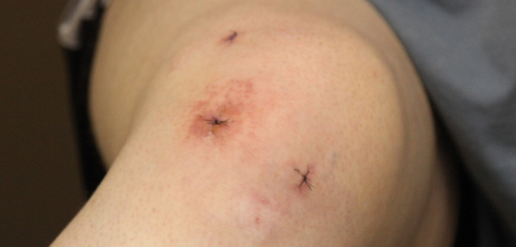 Knee Arthroscopy Surprising Contributor to Opioid Overuse