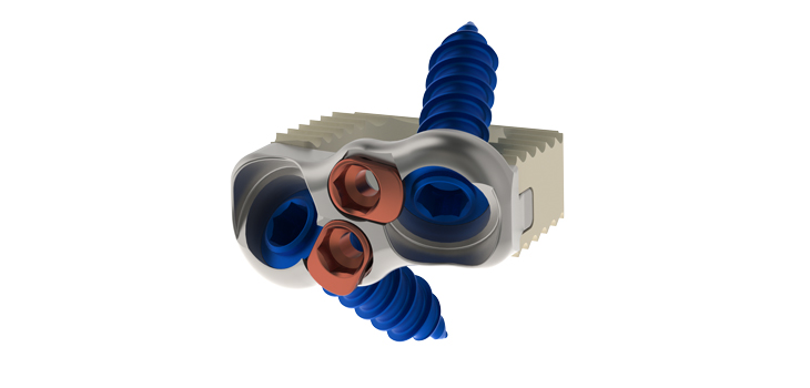 Amendia Introduces New Cervical Interbody Device