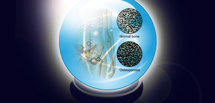 New Index to Predict Bone Loss