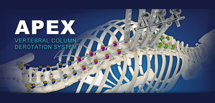 SpineCraft: 15, 000 Apex Surgeries!