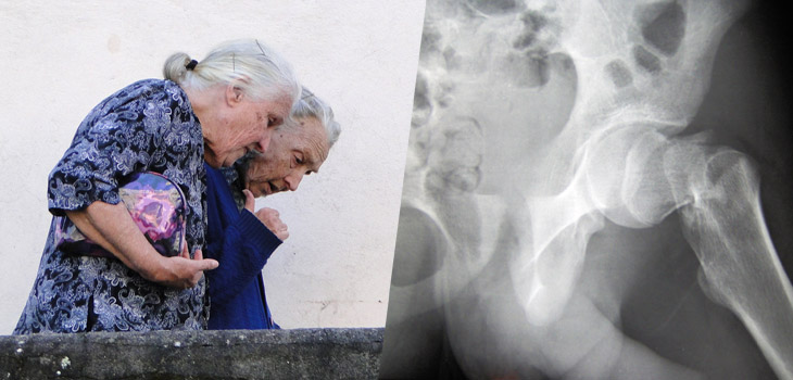 Elderly Hip Fracture Patients Not Told They Have Osteoporosis