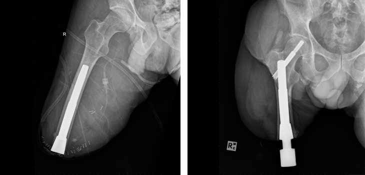 Three New Studies: Osseointegrated Implants for Amputees, Complicated Multiplanar Loads After ACL Surgery, and Causes of Hip Dysplasia