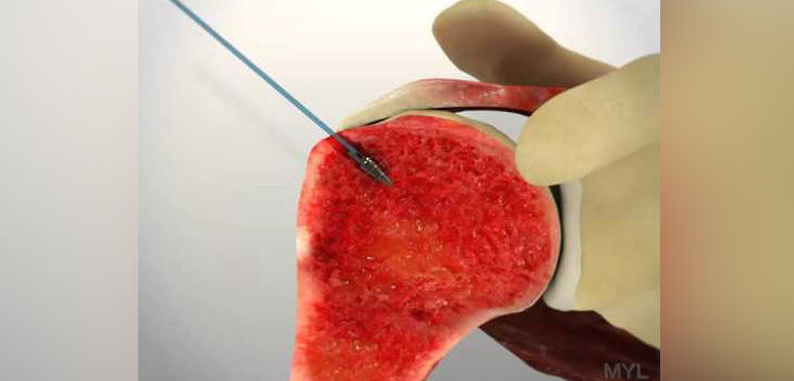 Suture Anchors Trump Transosseus Repair