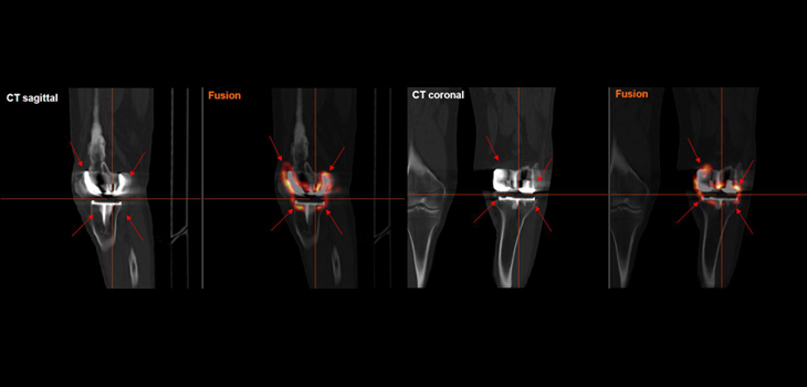 5.2 Million Total Knee Replacements