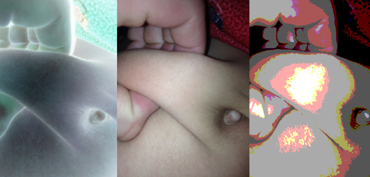 Reduced Cup Anteversion Problematic in Obese Patients?