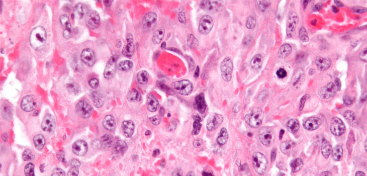 Sarcoma: Origin Cell Found!