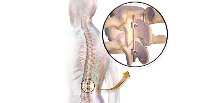 Risk of Spinal Fusion-Related Blindness Dramatically Decreased