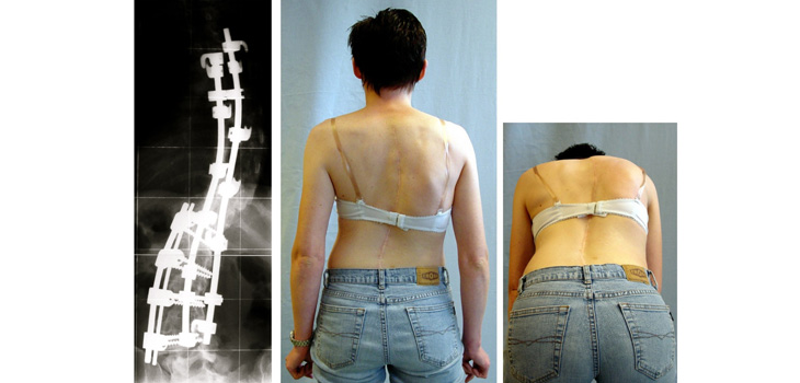Some Scoliosis Surgery Not Necessary!