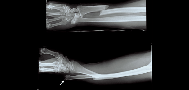 “Crisis” as High Risk Fracture Patients Go Undiagnosed, Untreated