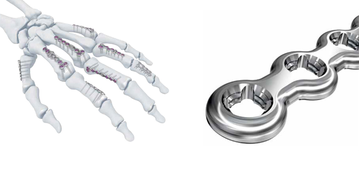 DePuy Synthes Launches Hand Fracture System