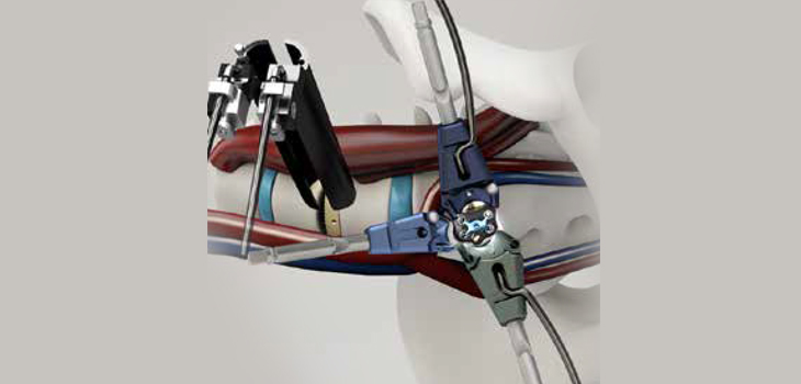 New OLIF System From Medtronic