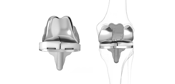 ConforMIS: Positive Results From iTotal CR Study