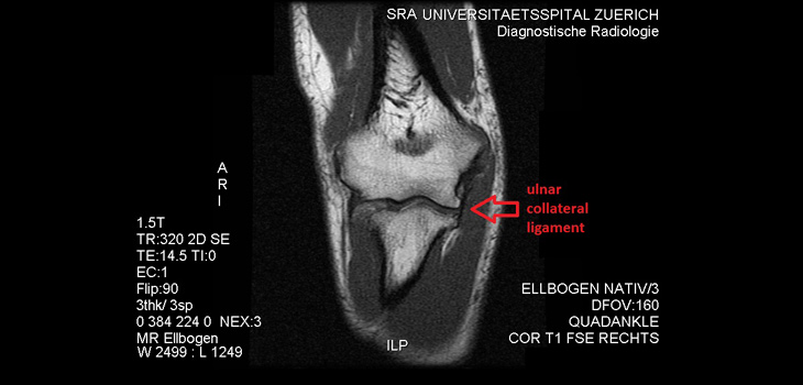 UCL: Location of Tears Helps Predict Non-Operative Success