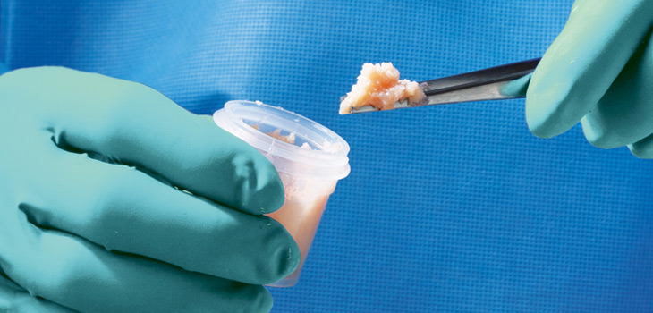 Trinity Bone Graft Shows 93.5% Fusion Rate in High Risk Patients