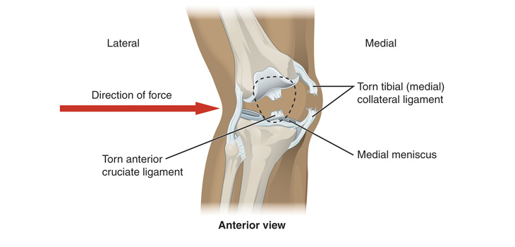 ACL: Increased Risk for Young Female Patients