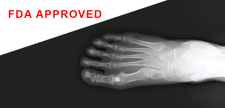 First Synthetic Cartilage Approved by FDA