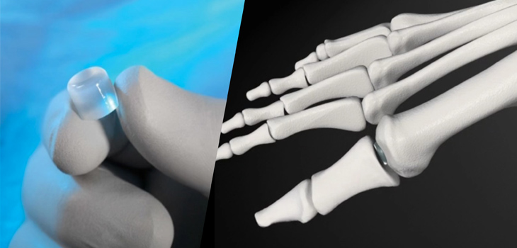 Cartiva: First OP Procedure With Synthetic Cartilage Implant