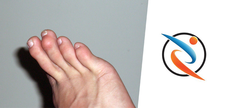 Hammertoe Correction System Earns FDA Clearance