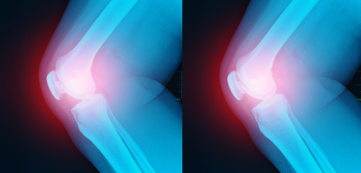Zimmer Biomet Acquires Joint Infection Diagnostic Company