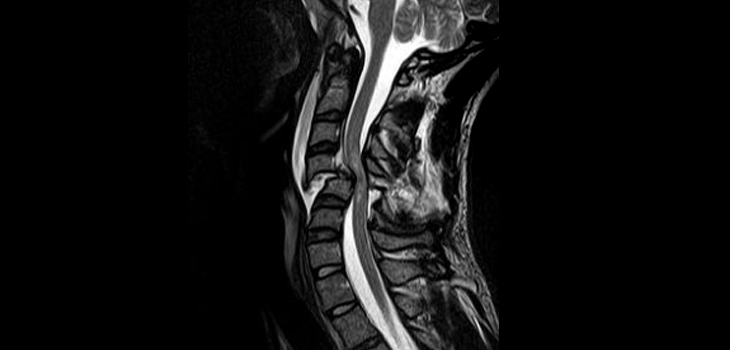 Modifiable Factors in Spinal Cord Injury