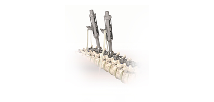 OrthoPediatrics Rolls Out BandLoc System