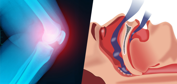 Joint Pain and Sleep Apnea: No Association