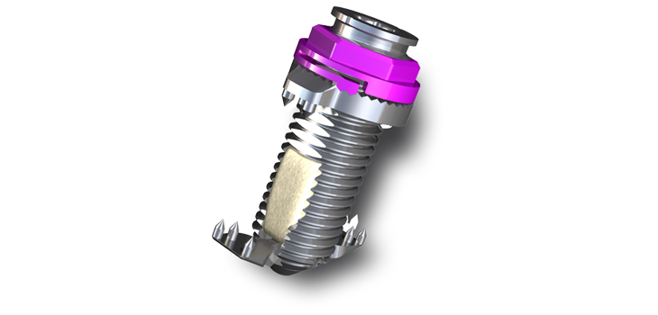 Spinal Simplicity Launches New Spinal Fusion Device